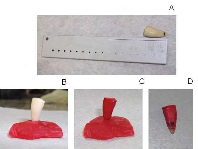 45 seguida, o excesso do material obturador foi cortado na região cervical com um condensador endodôntico aquecido, finalizando com a condensação vertical.