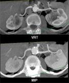 renal HTA reno-vascular