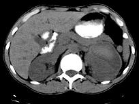 hematoma