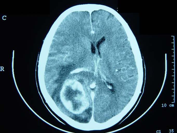 Neurocirurgia Carcinoma