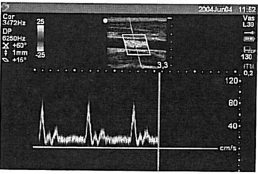 Doppler Pulsado (PW) / Doppler Contínuo (CW). Tamanho da janela (Só DP) Selecciona o tamanho de janela desejada. Traçado Espectral de Doppler 1.