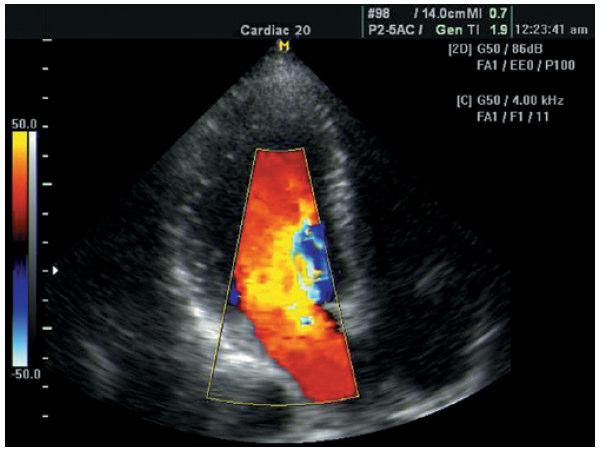 DOPPLER PULSADO IMAGEM MÉDICA EQUIPAMENTO (ECÓGRAFO) FLUXO CARDÍACO Útil no diagnóstico de muito