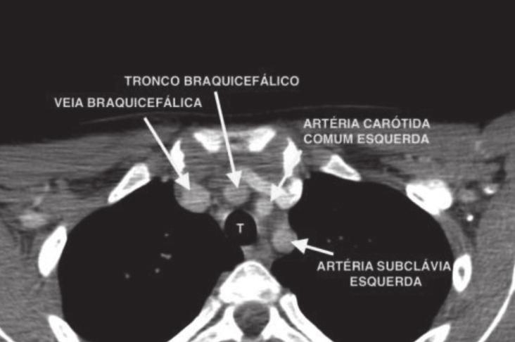 3 Cabeça e Pescoço 1. Anatomia radiológica básica Para interpretar corretamente patologias de cabeça e pescoço, é necessário estar familiarizado com a anatomia radiológica dessa região.