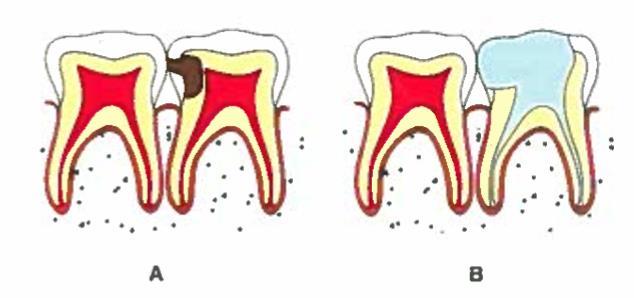 Tipo de dente: Algumas características do dente a tratar tais como a anatomia da coroa, o número, a forma e o tamanho das raízes, a função mastigatória que desempenha, a participação numa prótese