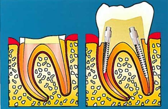 i. Complementos de retenção É comum que um dente endodonciado necessite de um sistema de retenção adicional, o qual pode ser obtido aproveitando unicamente os tecidos dentários remanescentes, entre