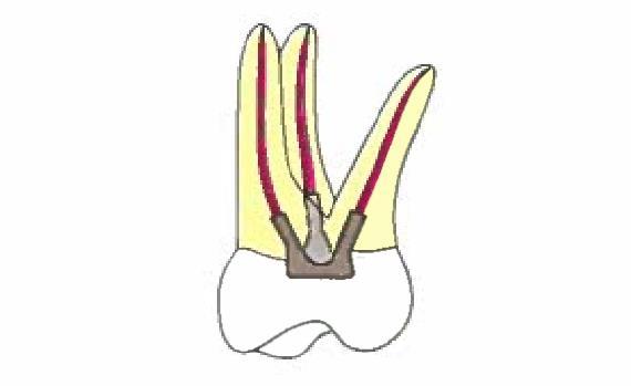 A preparação da cavidade deve apresentar resistência ao desgarre, garantindo a sustentação do coto dentário.