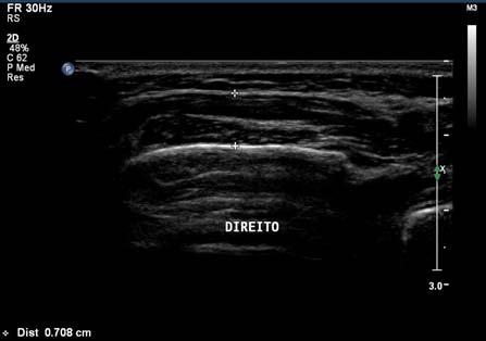 Introdução Estudos recentes utilizaram a ultrassonografia com o objetivo de medir os cortes musculares e correlacionar esses dados com patologias como a desordem temporomandibular (DTM), dor à