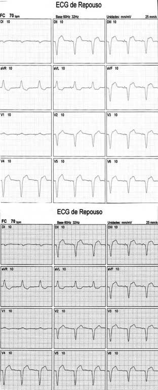 No caso nº 1, a substituição valvar aórtica produziria melhora da condição clínica, mas a estimulação ventricular direita já estava instalada e sua manutenção induziria um retardo na contração do