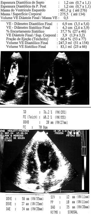 Figura 5 - Caso 1: Ecocardiograma. : pré-operatório; : evolução e a presença de cardiodesfibrilador já instalado, promoveu-se a estimulação biventricular 31.