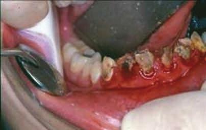 88 XIII Manual de OtOrrInOlarIngOlOgIa PedIátrIca da IaPO Figura 4. Cárie dentária rampante dos dentes inferiores e anteriores em uma criança após a reposição cirúrgica dos dutos salivares.