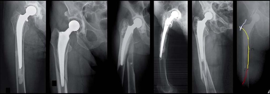 Fraturas periprotésicas em artroplastias da anca da cirurgia ortopédica atual, devido às múltiplas e complexas intervenções cirúrgicas exigidas, internamento hospitalar mais prolongado, maiores
