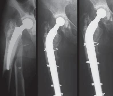 Rui Cabral utilizando hastes femorais não cimentadas longas com impactação femoral distal com fixação da fratura femoral através de cabos metálicos e/ou placas, com ou sem aplicação de enxerto ósseo