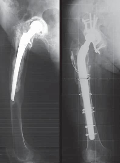 perdas ósseas femorais com enxerto ósseo alógeno (Figura 5); fraturas do tipo C fixação apenas da fratura com placas retas e parafusos e/ou cabos metálicos inseridos na placa (Figura 6); fraturas do