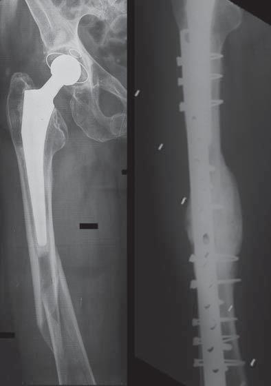 Fraturas periprotésicas em artroplastias da anca por 38 doentes (34%) relativamente ao seu estado clínico antes de sofrerem fratura periprotésica, pode ser atribuída aos descolamentos dos componentes