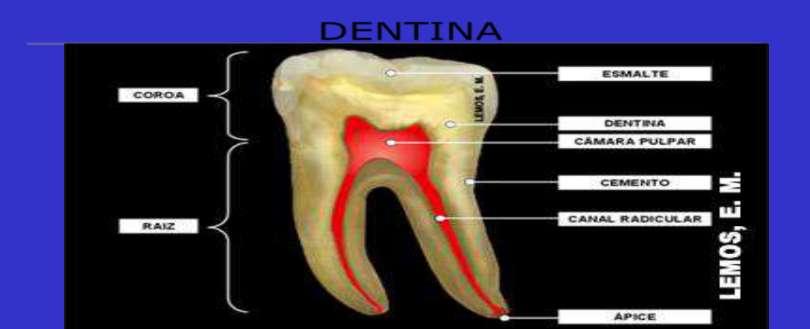 Invasão bacteriana de dentina e canais radiculares Progressão direta ou recorrente de uma lesão de cárie de esmalte; De cárie de superfície