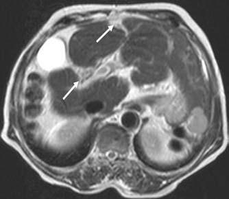 As imagens foram interpretadas buscando avaliar a presença ou ausência das seguintes alterações qualitativas hepáticas: a) alargamento de fissuras, caracterizado como identificação anormal de tecido