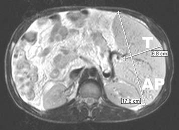 O limite superior da normalidade descrito na literatura, utilizando a US, é de 1 cm (3) ; f) diâmetro transverso do baço: medida realizada no nível do hilo