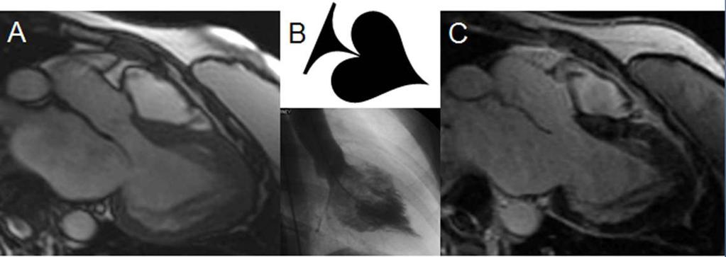 Figura 2 Cardiomiopatia hipertrófica apical. Hipertrofia parietal predominante no ápice com o sinal do ás de espadas, descrito nos estudos de ventriculografia.