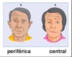 (iii) lesão do lado contralateral Paralisia Facial Central (i)