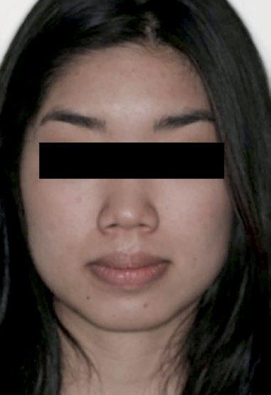 Ortoclínica D análise facial evidenciou um perfil convexo, e na vista