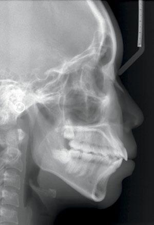 (N=6º, SN=84º, SN=78º). Os valores cefalométricos evidenciavam que a maxila apresentava-se suavemente protruída e a mandíbula retruída em relação à base do crânio.