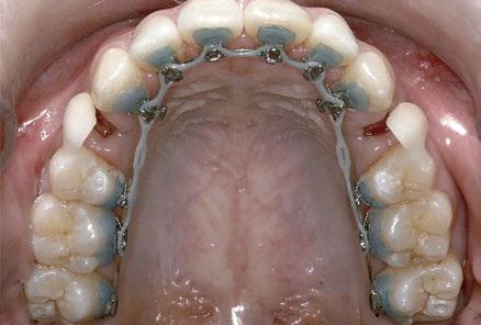 Figuras 9 Pôntico para preservar a estética e fechamento de espaço por deslizamento nos arcos superior () e inferior ().