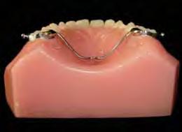 Os 1 os molares permanentes superiores foram bandados (Kit com bandas universais Morelli) e unidos entre si por uma barra transpalatina, confeccionada com