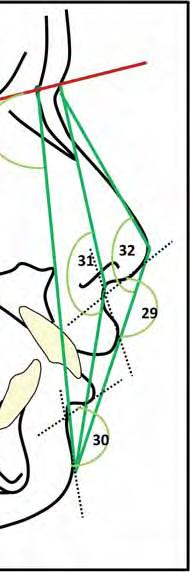 78 Quadro 5 - Descrição das grandezas cefalométricas angulares do perfil tegumentar Medidas Descrição 28.SN.Pg Ângulo facial. 29.Nasolabial Ângulo formado entre a linha columela e o lábio superior.