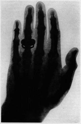 O que Röetgen ganhou? Figura 3 - Primeira radiografia mostrando a mão da esposa de Röetgen: Anna Bertha Ludwig. Publicação do artigo em 1895: Sobre uma nova espécie de raios.