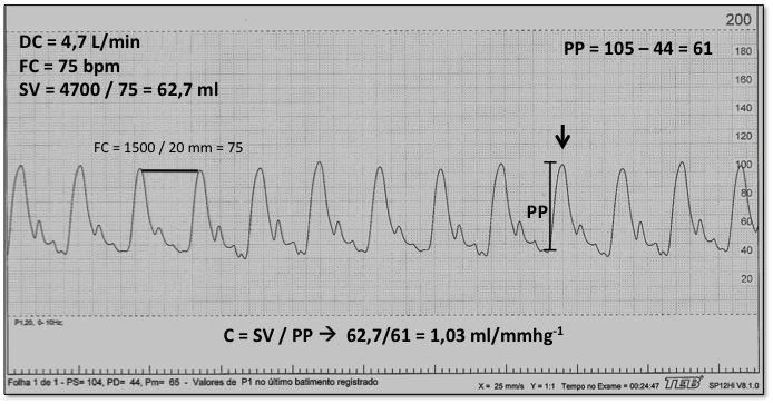 45 Figura 5 Cálculo CVP a partir de traçado curva hemodinâmica DC Débito
