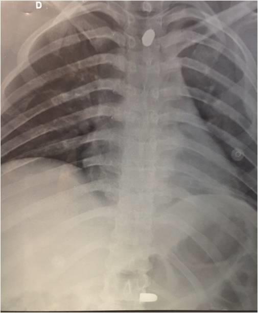 Neurocirurgia do Hospital César Leite Figura 3: Tomografia de coluna toraxica(t2): Figura 4:Tomografia de coluna toraxica(t2): Após 9 dias o paciente evoluiu com disestesia severa em território