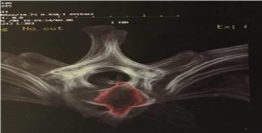 3 RESULTADOS E DISCUSSÃO As lesões medulares por arma podem causar danos neuronais significativos, pois o projétil transfere energia para o tecido, sendo a massa, a velocidade e a composição da bala