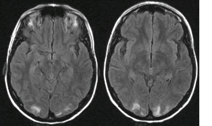 77 subcortical T2 hyperintensity without enhancement, apparent on both occipital lobes (Figure 1). MP pulse was interrupted, and analgesics were prescribed.