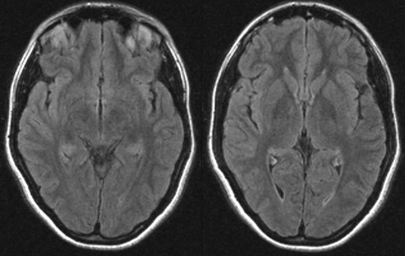 Three weeks later, a new brain MRI showed no cortical or subcortical T2 hyperintensity (Figure 2). Figure 1.