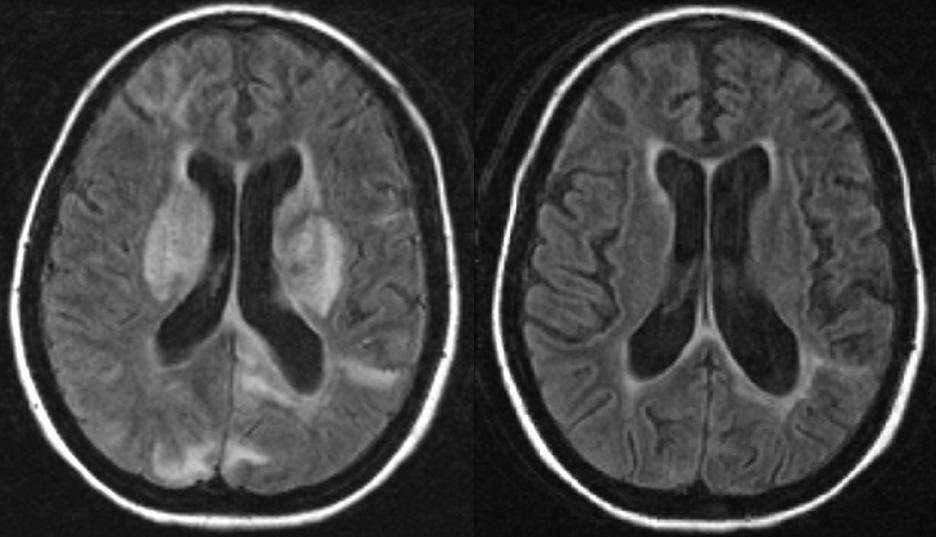 78 3a). Neurological improvement was obtained by adjusting blood pressure levels. A brain MRI carried out two weeks later showed impressive regression of findings attributable to PRES (Figure 3b).