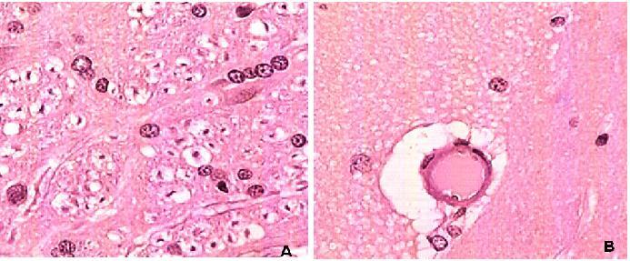 99 Figure 4: Histology of brain stained with H&E (400x) shows an increase perivascular space.