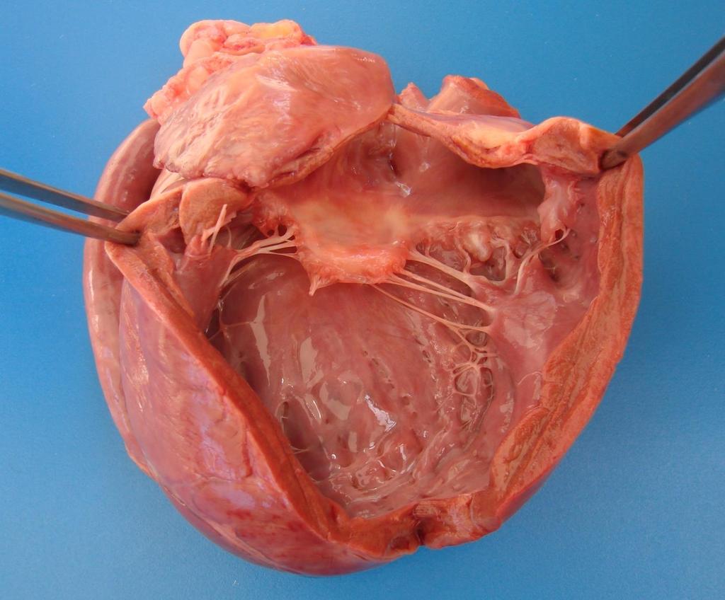 Miocardiopatia