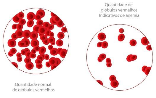 Avitaminose (carência) Anemia perniciosa poucas hemácias Distúrbios