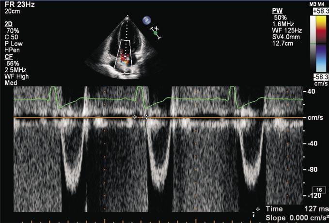 Na projeção paraesternal transversal ao nível dos vasos da base, o volume amostral do Doppler pulsátil é posicionado na via de saída do ventrículo Figura 3 : Medida do tempo de preejeção pulmonar.