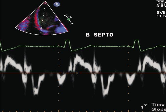 O Doppler tecidual avalia a contração longitudinal miocárdica e possibilita a medida do atraso eletromecânico em cada segmento do ventrículo esquerdo.
