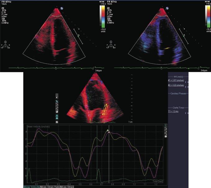 Figura 6 : O movimento dos segmentos miocárdicos pode ser observado através da padronização das velocidades pela escala de cores.