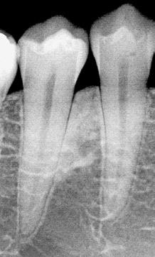 maior de mediadores, induzindo reabsorções ósseas mais aceleradas na parte mais cervical da face periodontal da crista óssea alveolar.