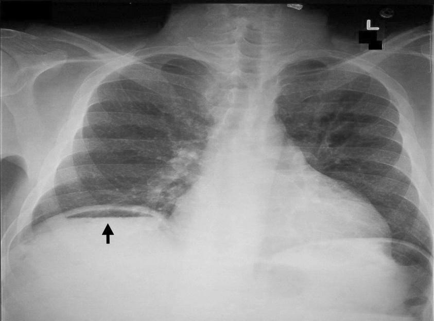 Figura 1 Radiografia de abdome com presença de níveis hidroaéreos indicando obstrução intestinal. Stoker et.