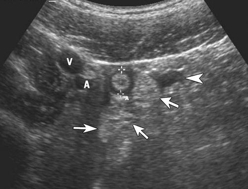 exemplos de diagnósticos que podem ser confirmados com a ultrassonografia. Patologias pélvicas como gestação ectópica são usualmente diagnosticadas pela ultrassonografia.