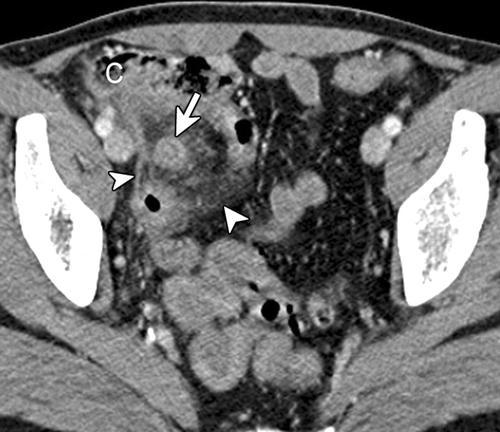 Tomografia Computadorizada A tomografia computadorizada de abdome tem uma alta acurácia para diagnosticar muitas doenças específicas causadoras de dor abdominal aguda.