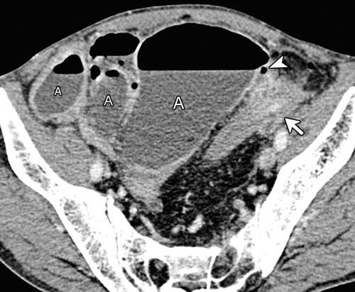 O Colégio Americano de Radiologia indica que a tomografia computadorizada pode ser usada como primeiro exame para praticamente todos os casos de abdome agudo, porém devem ser considerados os riscos