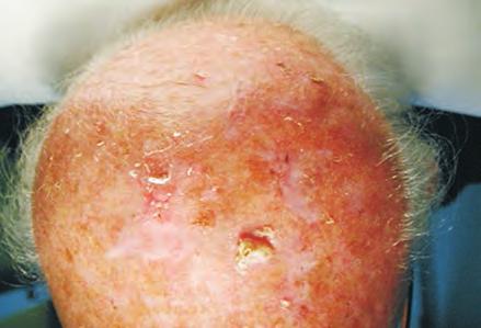 obtained validate the concept of field cancerization to the skin, showing subclinical changes in the normal appearing skin surrounding the actinic keratoses.