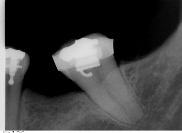 20 colaterais indesejados como a extrusão do dente verticalizado e intrusão do segmento anterior de ancoragem.