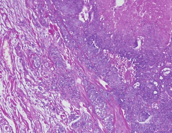 between 2005 and 2010, identified 182 cases (Table 1). Pilomatricomas accounted for 31 of these tumors, with a single case of malignant behavior; the one reported here.