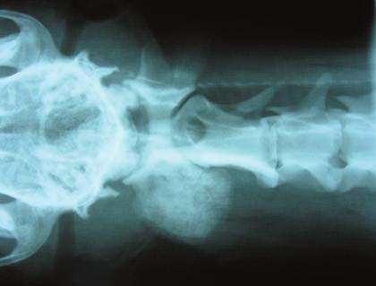 Noiva RM et al. RPCV (2012) 107 (581-582) 101-104 Radiographic studies were performed, showing bone proliferation over the left wing of C1 (Figure 3).